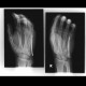 Boxer's fracture: X-ray - Plain radiograph